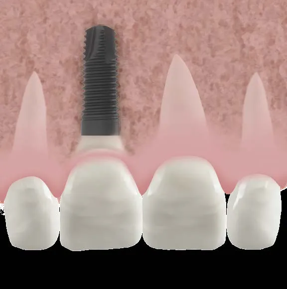 Las consecuencias de la perdida de dientes y las soluciones modernas