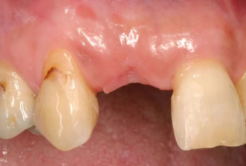 absceso dental tratamientos efectivos y cómo manejar la infección