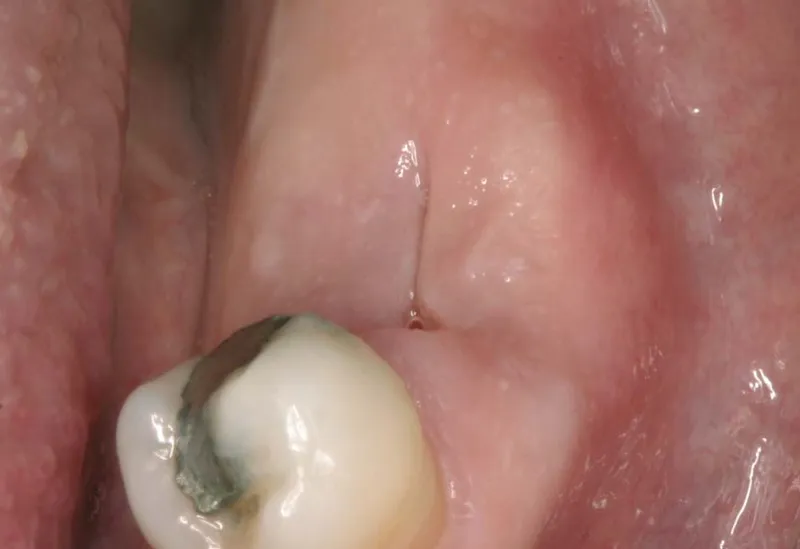 caries clase 2 y su tratamiento efectivo