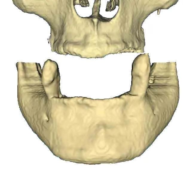 huesos de la mandibula