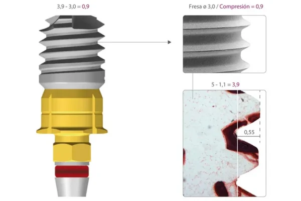 implantes dentales sin tornillos