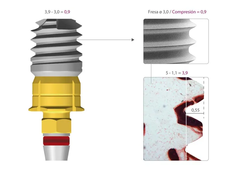 implantes dentales sin tornillos