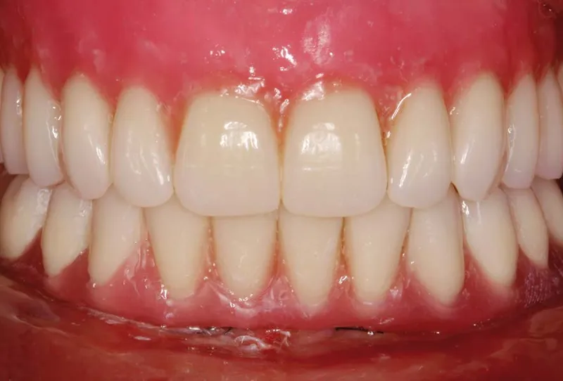 sonrisa gingival botox: cómo puede mejorar tu sonrisa