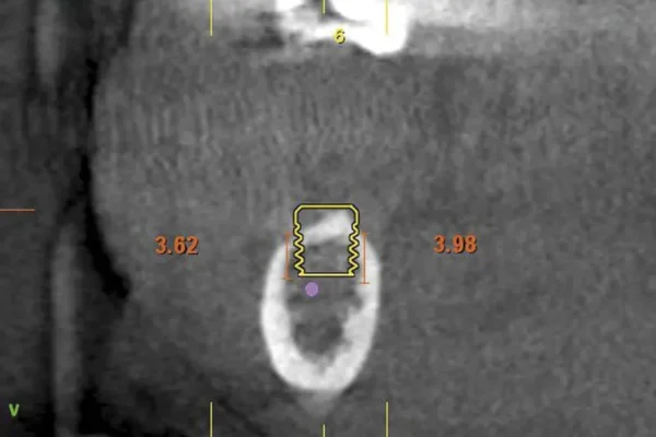 straumann tissue level