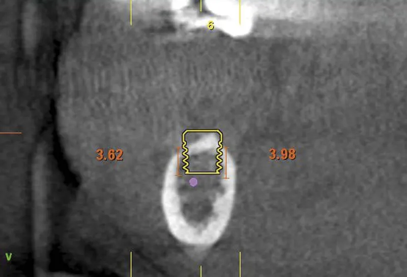 straumann tissue level