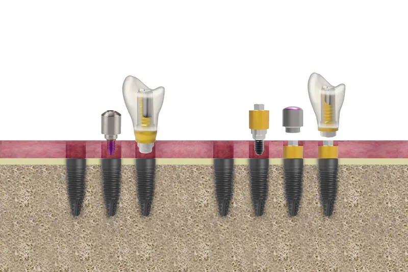 tipos de implantes dentales y sus diferencias clave