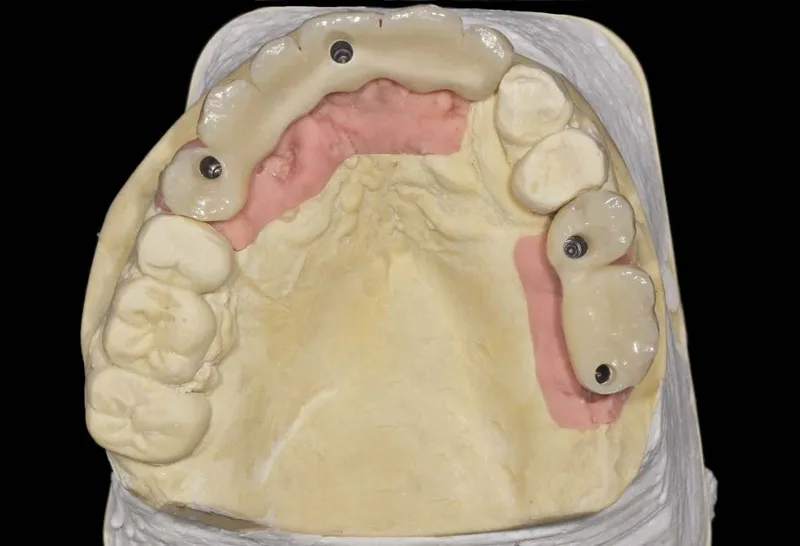 beneficios de los implantes dentales vs prótesis removibles, ventajas y diferencias