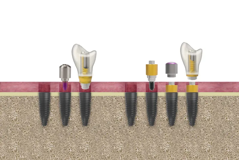 implantes dentales duración y vida útil según los expertos