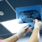 ¿Es necesario realizarse radiografias para un implante dental