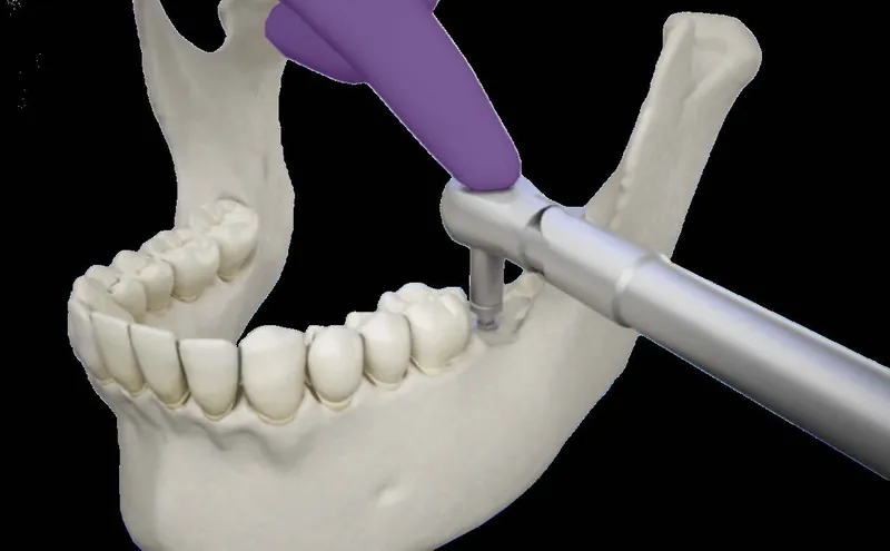 osteointegración en implantes dentales, proceso clave para su éxito